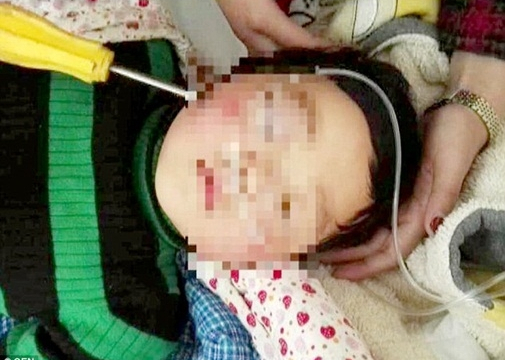 Bé gái 1 tuổi thoát chết khi chiếc tua vít dài xuyên qua đầu